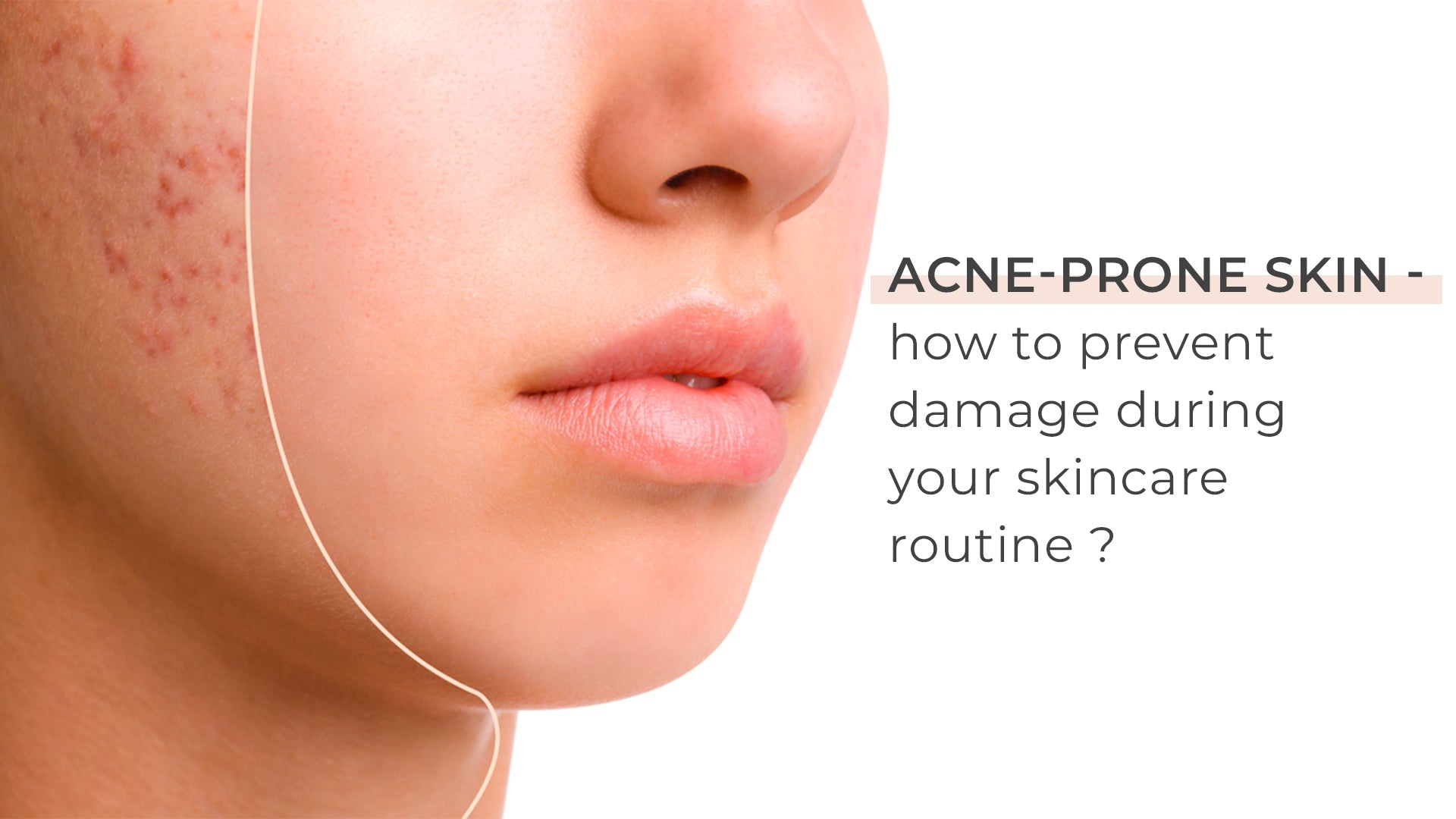 ACNE PRONE SKIN