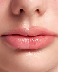 VT COSMETICS Reedle Shot Lip Plumper Beginner – 4.3g